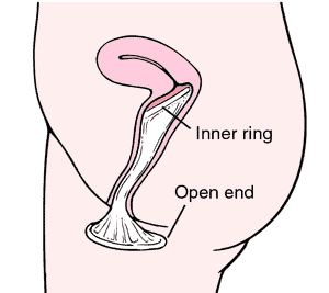 Female condom | definition of female condom by Medical dictionary